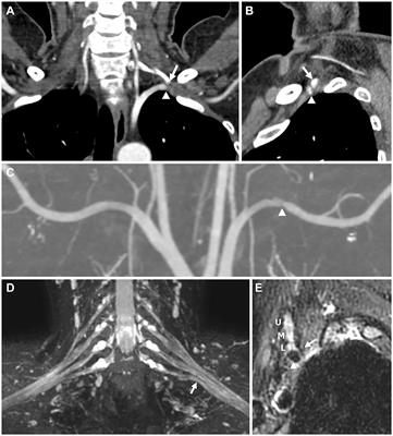 Case Report: Neurogenic Thoracic Outlet Syndrome Without Electrophysiologic Abnormality